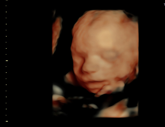 3D ultrasound image at 25 weeks
